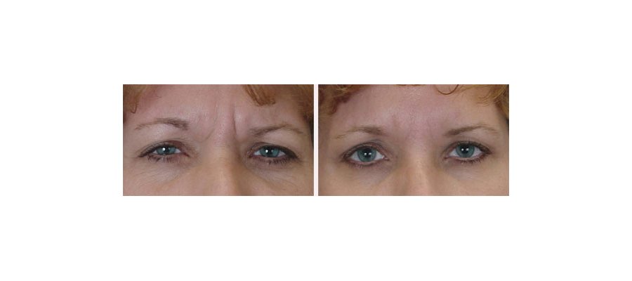 BOTOX before and after - actual patient