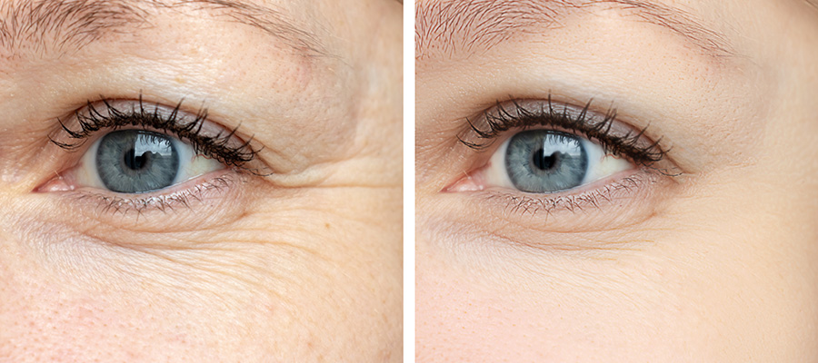 Stock photo of woman before and after BOTOX treatment for Crow's feet.